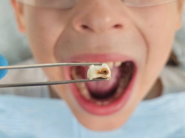 Best Emergency Gum Treatment in Charleston, MS
