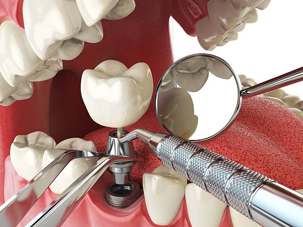 Best Emergency Dental Care for Broken or Chipped Teeth in Charleston, MS